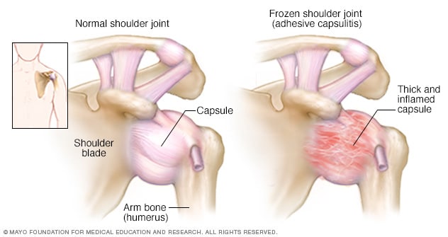 Ilustración de la articulación del hombro 
