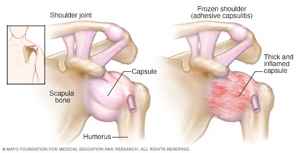Ilustración de la articulación del hombro 
