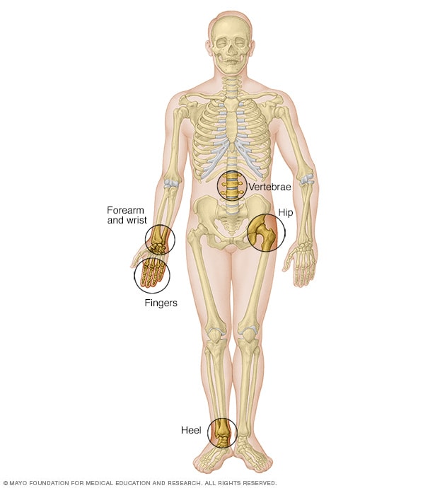 El esqueleto y las ubicaciones para análisis de densidad ósea