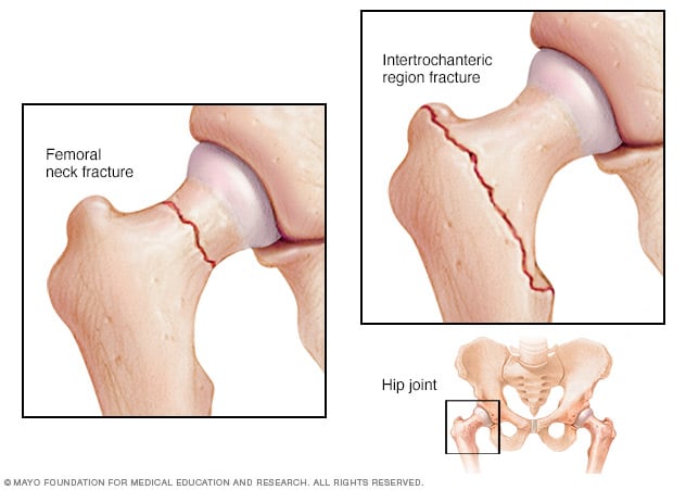 The two most common types of hip fractures