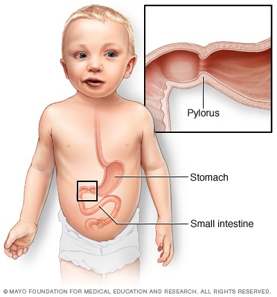 The location of the pylorus