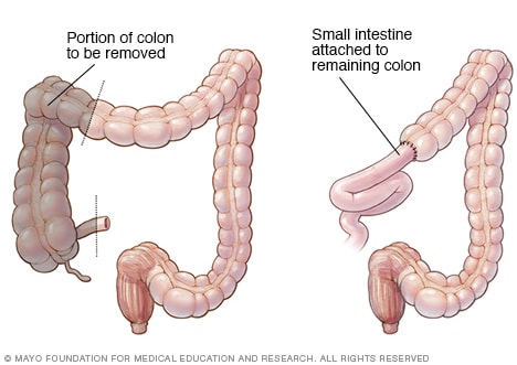 Ilustración de una hemicolectomía derecha
