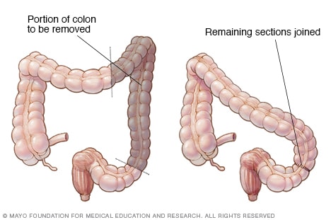 Ilustración de la hemicolectomía izquierda
