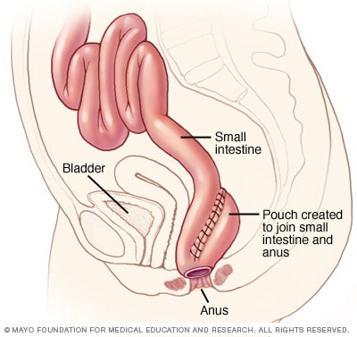 Ilustración de anastomosis ileoanal 
