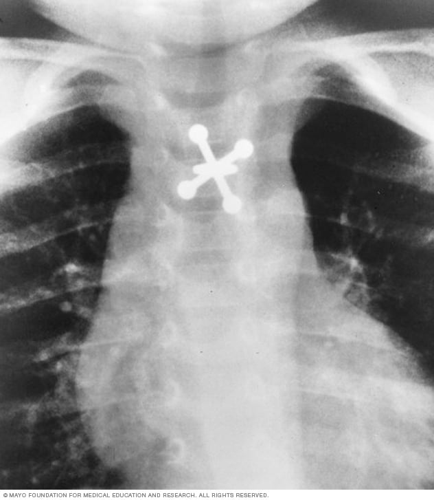 X-ray of swallowed jack