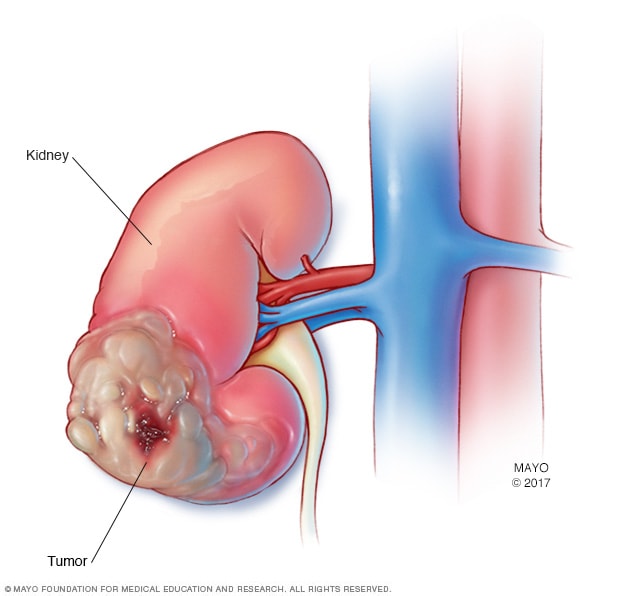 Kidney Cancer Symptoms 