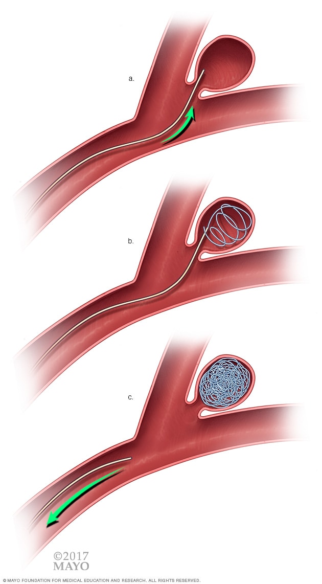 Endovascular coiling