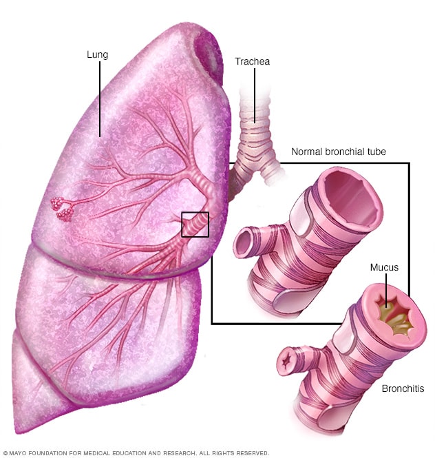 Bronquitis - Mayo Clinic