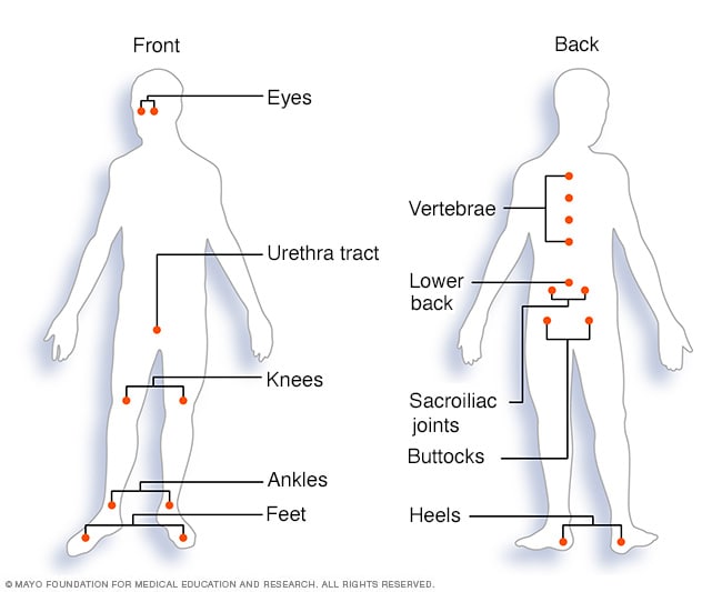 Common inflammation sites in reactive arthritis