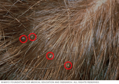 human lice on hair