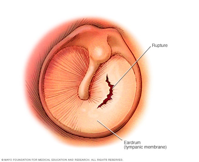 mestre bølge hovedlandet Ruptured eardrum (perforated eardrum) - Symptoms and causes - Mayo Clinic