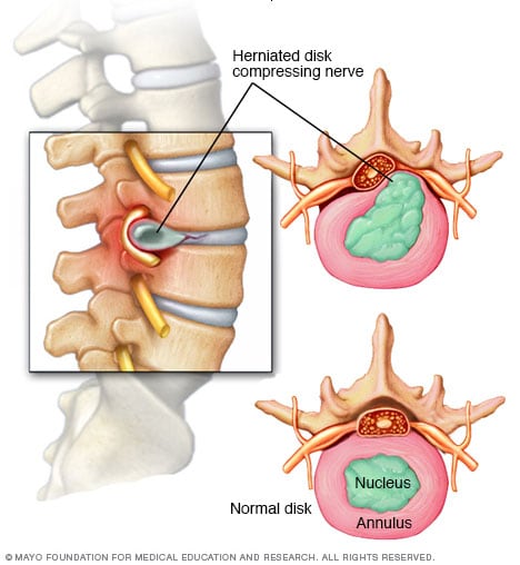 Illustration of how a herniated disk can compress a spinal nerve