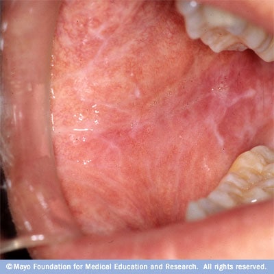 Oral lichen planus