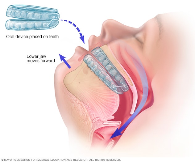 Apnea obstructiva del sueño - Diagnóstico y tratamiento - Mayo Clinic