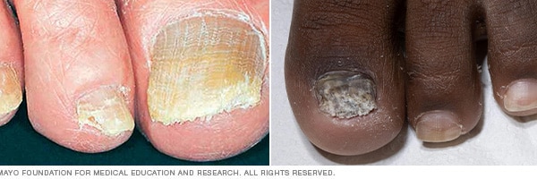 Toenail Fungus: Natural Treatment, Symptoms and Causes - Dr. Axe