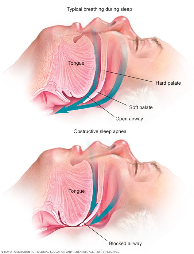 مجرى هواء مفتوح خلال التنفس المعتاد أثناء النوم ومجرى هواء مسدود لدى شخص مصاب بانقطاع النفس الانسدادي النومي.