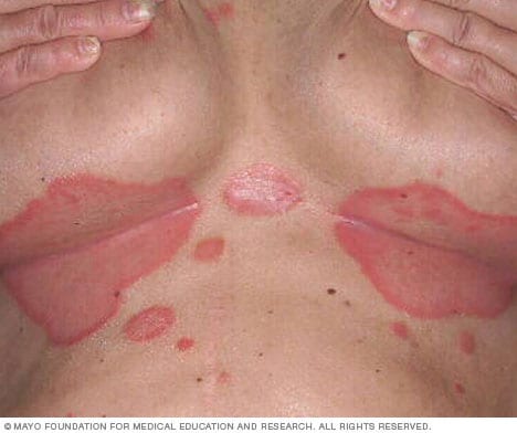 psoriasis painful skin