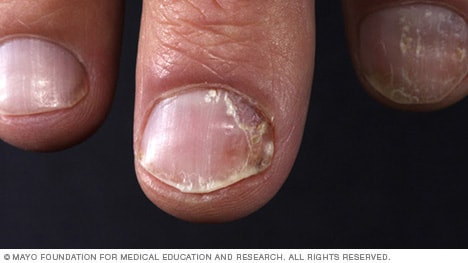 Nail matrix psoriatic manifestations visible on the nail plate 12 |  Download Scientific Diagram