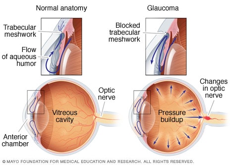 Glaucoma de ángulo abierto