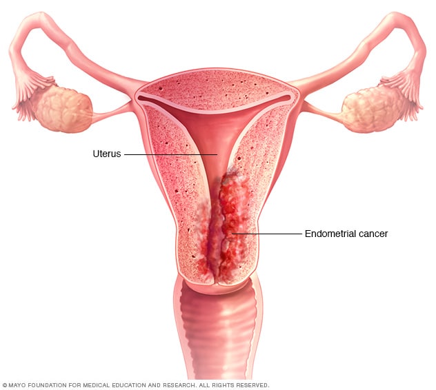 Illustration showing endometrial cancer 
