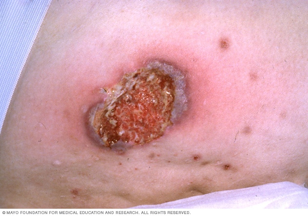 Pioderma gangrenoso avanzado