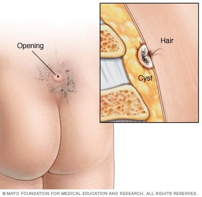 Pilonidal cyst - Symptoms and causes - Mayo Clinic Pilonidal cyst - Symptoms and causes - Mayo Clinic