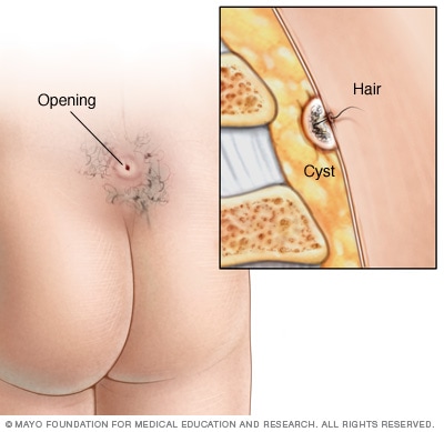 Pilonidal cyst - Symptoms and causes - Mayo Clinic