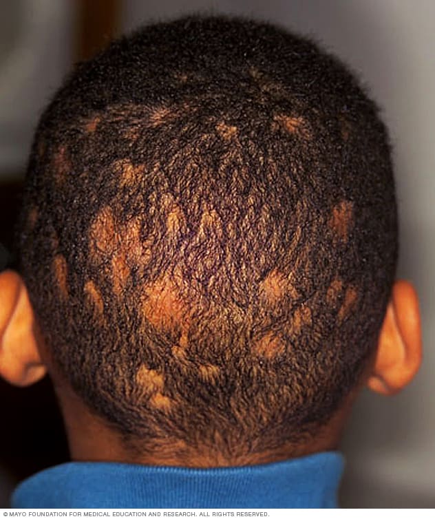 Ringworm (scalp) - Symptoms and causes - Mayo Clinic