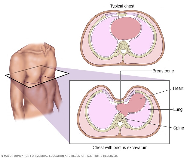 Pectus Excavatum diagram