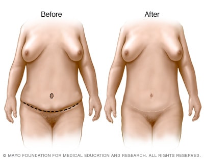 Resultados de la cirugía estética de abdomen