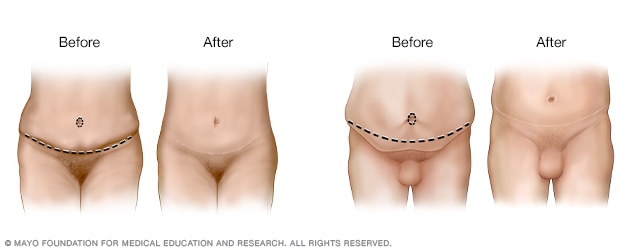 Tummy tuck results