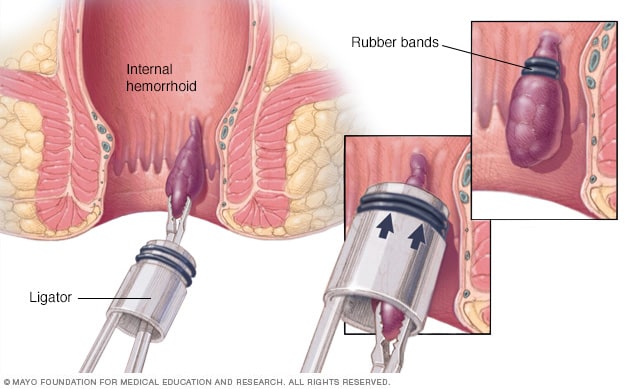 Rubber Band Ligation Of Hemorrhoid