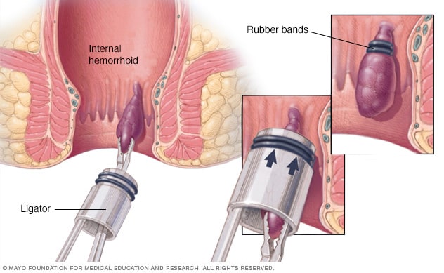 With rubber band ligation, rubber bands are slipped around the base of the haemorrhoid, cutting off blood supply and causing the lump to fall off. Image: Mayo Clinic