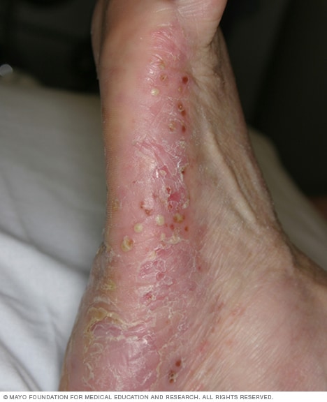 psoriasis pustular feet)
