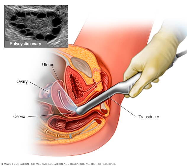 Transvaginal ultrasound 