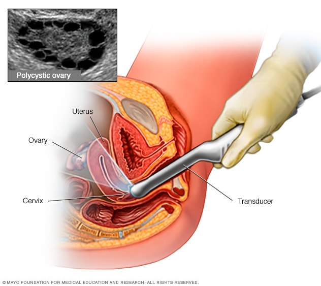 Ecografia transvaginal mostrando ovário de aspecto normal, com a