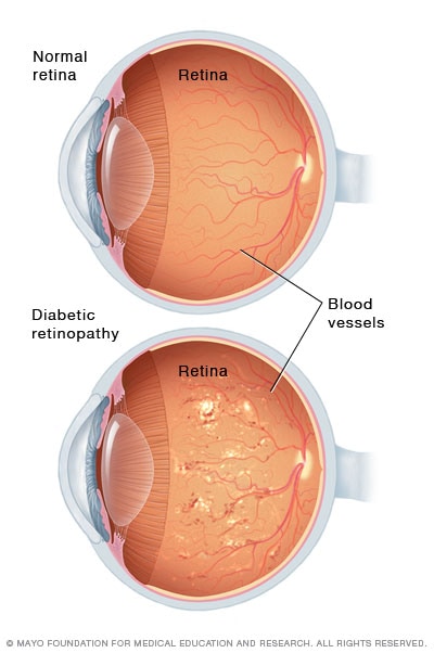 diabetic neuropathy symptoms eyes