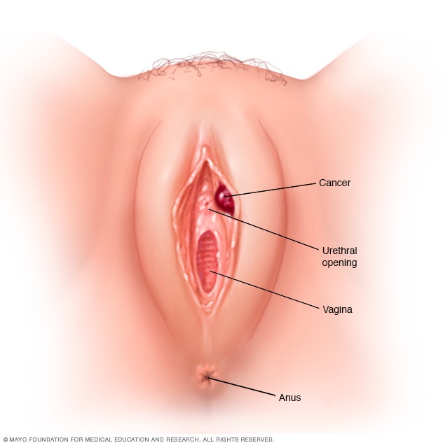 Vulvar Cancer Pictures Mayo Clinic