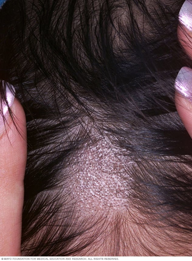 Closeup of ringworm of the scalp Mayo Clinic