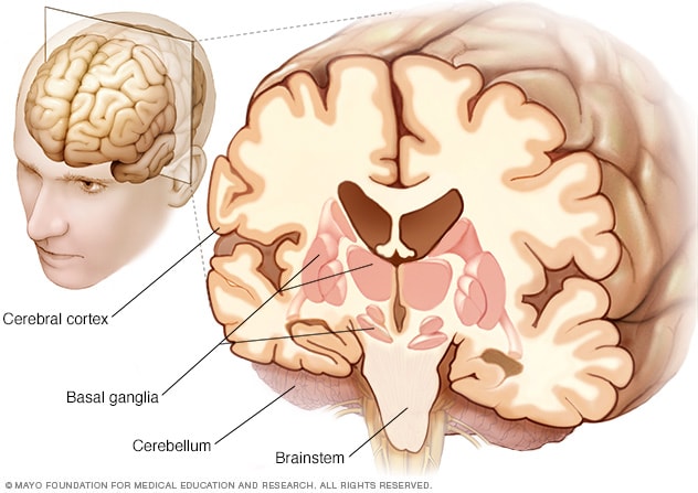 Affected parts of the brain