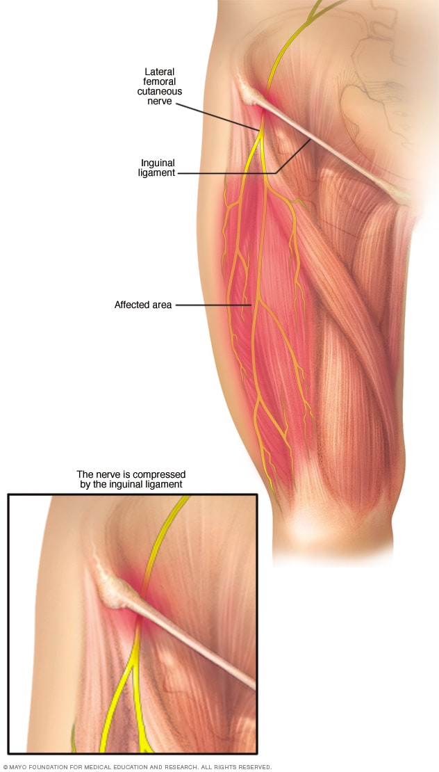 Meralgia Parestesica Sintomas Y Causas Mayo Clinic