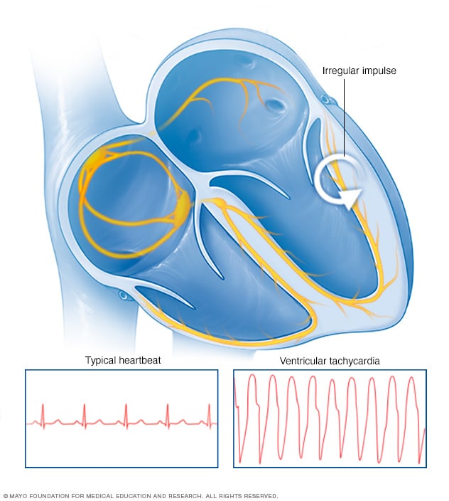 Premature Ventricular Contractions Pvcs Symptoms And Causes Mayo Clinic