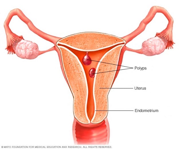 Endometrial Polyp Size Chart