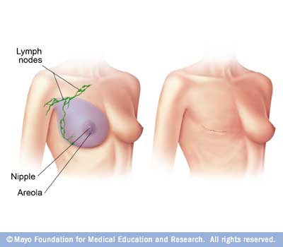 رسم توضيحي لاستئصال الثدي الجذري المعدل 