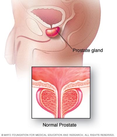 prostatitis symptoms)