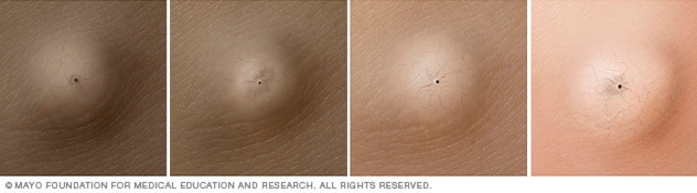 Epidermoid cyst on four different skin colors.