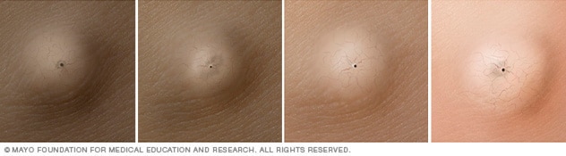 herpes nariz causas