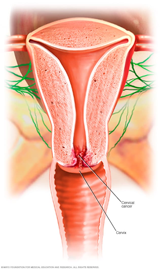 Stage One signs of cervical cancer? Symptoms Vaginal bleeding after  intercourse, between periods or after menopause. Watery, bloody vaginal  discharge, By Upsillon Care