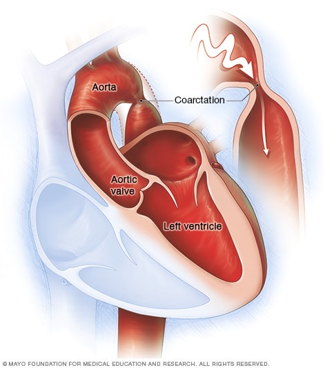 Coarctation Of The Aorta Symptoms And Causes Mayo Clinic