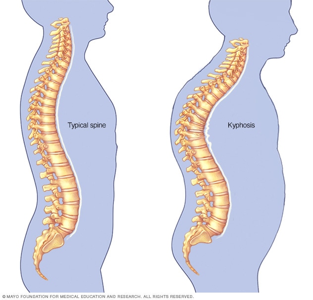 Kyphosis 